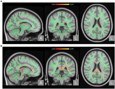 White matter microstructural alterations in patients with neuropathic pain after spinal cord injury: a diffusion tensor imaging study